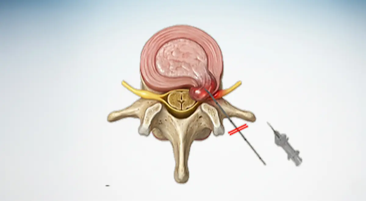 Cirugia de Columna Minimamente Invasiva