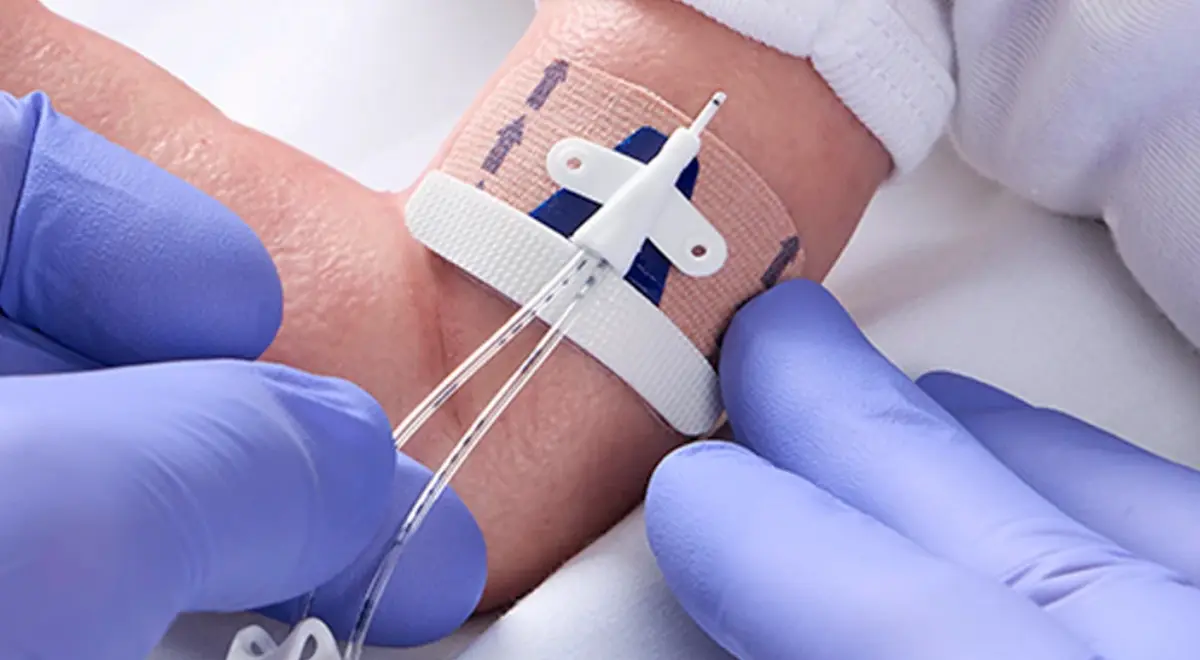 Fijacion De Cateteres Neonatales
