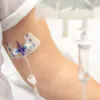 FlexGRIP Alpha sistema fijación sin suturas para catéter CVC PICC y Midline, dispositivo sujeción hospitalario