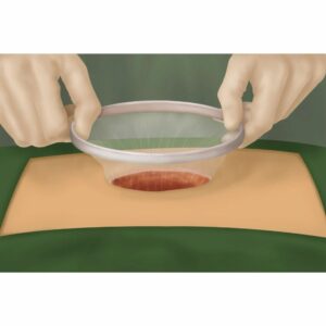 WZIPS BS 50 25 Anillo Retractor F3 1