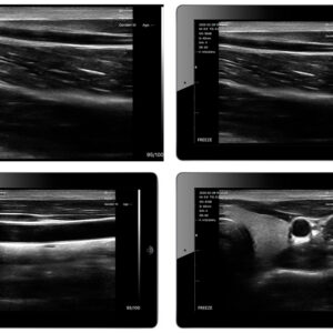 Ecógrafo portátil inalámbrico GIMA Viatom Linear – Sonda lineal 7,5-10 MHz – Ref. 33931