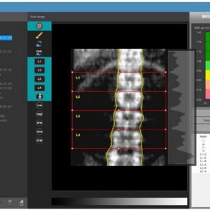 Excellus DEXA Half-Body Fan-Beam System