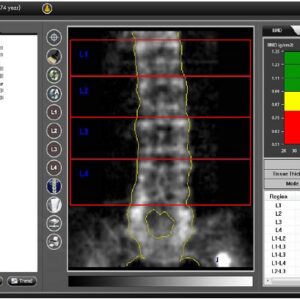 PRIMUS DEXA Full-Body Fan-Beam System