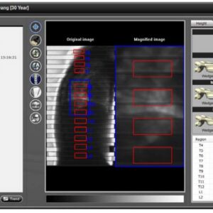 PRIMUS DEXA Full-Body Fan-Beam System