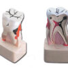 Modelo Anatómico de Diente con Patología de Caries 4X – Esmalte, Dentina y Pulpa | GIMA (Ref. 40212)