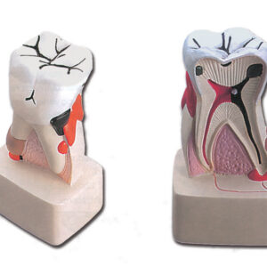 Modelo Anatómico de Diente con Patología de Caries 4X – Esmalte, Dentina y Pulpa | GIMA (Ref. 40212)