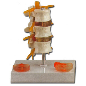Modelo Anatómico de Hernia Discal Lumbar – 3 Vértebras con Discos Herniados y Nervios Espinales (GIMA, Ref. 40180)