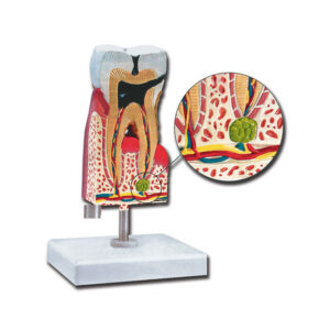 Modelo Anatómico de Molar Inferior con Caries Ampliado 10x | Maqueta Didáctica de Patologías Dentales para Enseñanza (GIMA Ref. 40214)