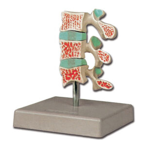 Modelo anatómico de osteoporosis avanzada con 3 vértebras comparativas (sana, estadio inicial y avanzado) – GIMA, Ref. 40185