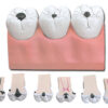 Modelo Anatómico Dental de Caries – 7 Piezas, 4x Tamaño Natural | Réplica de 3 Dientes para Docencia en Odontología (Ref. GIMA 40211)