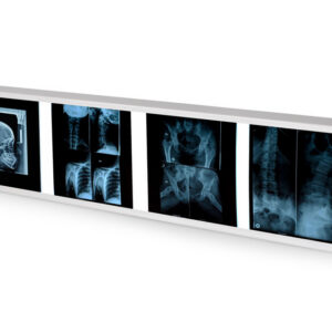 Negatoscopio cuádruple GIMA 38x153 cm – Light Box de 4 paneles con luz fría 6.500 K para lectura de placas de radiología (Ref. 27368)